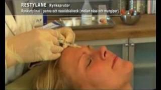 Restylane och Botox behandling [upl. by Yeoz85]