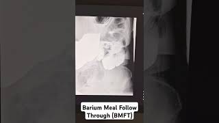 Barium Meal Follow Through BMFT barium xray radiology hospital students study [upl. by Darreg]