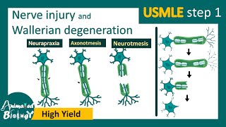 Nerve injury  Wallerian degeneration  Mechanism of wallerian degeneration  USMLE [upl. by Altheta987]