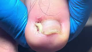 Very severe ingrown toenail severely inflamedprofessional treatment pedicure onychomycosis [upl. by Sima]