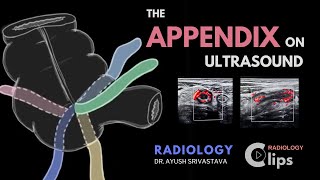 The Appendix on ultrasound and Acute appendicitis  Radiology [upl. by Cecelia]