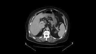 Pancreatic adenocarcinoma [upl. by Nivek129]