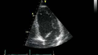 APICAL VIEW 4 CHAMBERS  NORMAL STUDY [upl. by Levey]