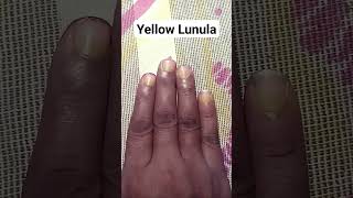 Yellow Lunula Chand 🌒 Sings in Hand Palmistry Dikki astrology palmistry astrology motivation [upl. by Tsyhtema]