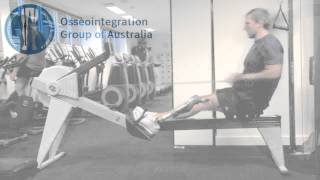 Benefits of Osseointegration  Patient Video [upl. by Schonthal]