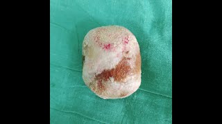 MULTIPLE STONE IN URINARY BLADDER [upl. by Fugate473]