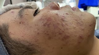 ACNE TREATMENT DOLLY ACNE  Blackheads On Boy Face 2024 002 [upl. by Enilegna]