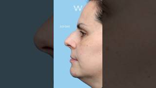 Before and after Rhinoplasty Nose Job results to remove a dorsal hump and smooth down nose bridge [upl. by Bertha]