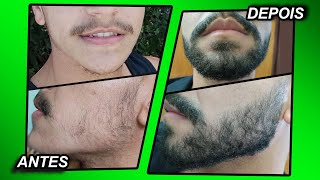 2 ANOS USANDO MINOXIDIL Kirkland e foligain [upl. by Leopoldeen]