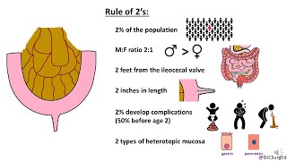 Meckel’s Diverticulum [upl. by Kolnick]