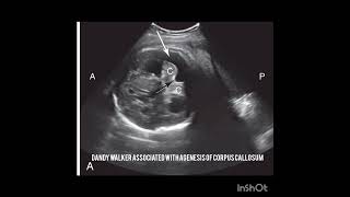 Ultrasound of Dandy Walker Abnormality  from the book Requisites of Ultrasound Chap 15 [upl. by Delwyn]