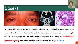 Lacrimal sac tumors 0 [upl. by Newsom898]