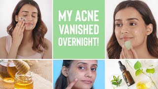 How To Make Your Acne Disappear Overnight  4 Home Remedies For Pimples [upl. by Zetana]