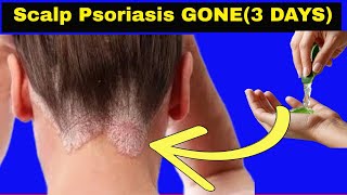 Cure Scalp Psoriasis in 3 Days Fast Itchy Scalp Relief [upl. by Signe278]