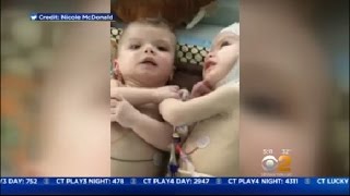 New Video Of Twins After Separation Surgery [upl. by Neroc]