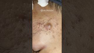 Blackheads blackheads treatments sacdepspa [upl. by Kare]