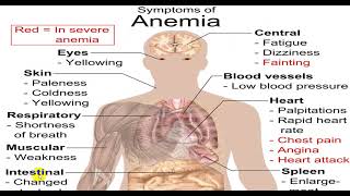 MICROCYTIC HYPOCHROMIC ANEMIA 4TH YR [upl. by Notsahc]