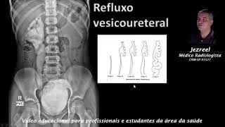 Refluxo vesico ureteral [upl. by Noreht]