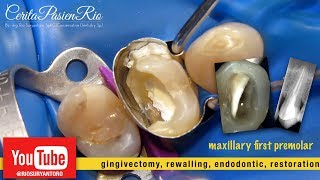 perawatan saluran akar gigi endodontic treament premolar disertai gingivectomy dan rewalling [upl. by Arjun]