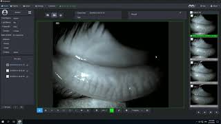 Meibomian Gland Analysis in Mediview [upl. by Raseda237]