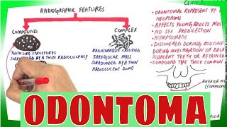 Odontoma  Types Clinical features Histopathological Features amp Treatment [upl. by Pia]