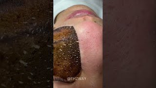 AMAZING Blackhead Removal by Brown Mask Peeling [upl. by Ellynn706]