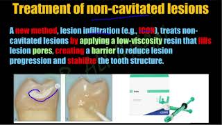 caries activity prevention treatment amp minimal invasive caries removal methods  operative 4 Lec5 [upl. by Caines]