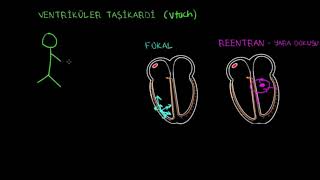 Ventriküler Taşikardi VT Fen Bilimleri Sağlık ve Tıp [upl. by Ahsenek]