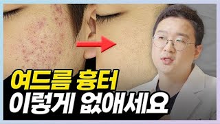 여드름흉터 없애는 법 다 알려드립니다 안보면 손해 [upl. by Absa]