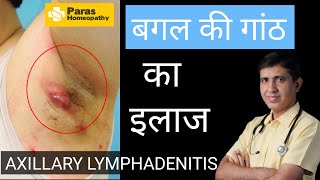 बगल की गाँठ  Axillary Lymphadenitis  Armpit Lymph Nodes Swollen  Swollen Lymph Nodes Treatment [upl. by Navarro]