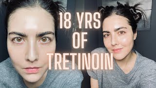 Not Seeing Results with RetinA TRETINOIN Watch This Before You Quit amp Avoid My Biggest Mistake [upl. by Coridon]