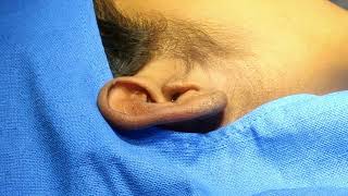 Intra lesional Triamcinalone Injection in earlobe Keloid under earlobe block [upl. by Carbo]