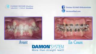 Cas Clinique  DAMON SYSTEM [upl. by Zahavi]