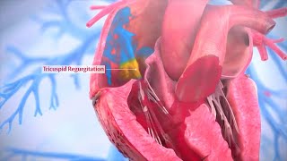 Tricuspid Valve Repair  Triluminate Clinical Trial [upl. by Shani]