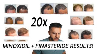 20 Finasteride and Minoxidil before and after Results NW2  NW56 [upl. by Con926]