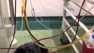 Plasmapheresis in Renal transplant with severe AMR Dr Sandeep kumar garg [upl. by Jenilee690]