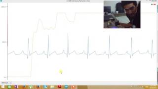 ECG and PPG to extract PTT for Cuffless blood pressure [upl. by Nahpos409]