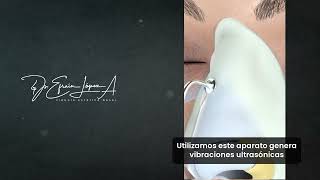 Rinoplastia Ultrasónica [upl. by Janenna]