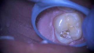 Removal of a Failing Dental Sealant [upl. by Lletnohs]