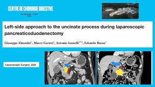 Laparoscopic Leftside approach to uncinate process during pancreaticoduodenectomy [upl. by Kayle830]