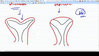 Difference between Bicornuate and Septate Uterus [upl. by Apicella]