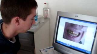 porcelain crowns veneers Tijuana Medical Tourism [upl. by Antin377]