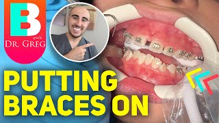 Getting Braces Put On and COLORS Vlog of Time Lapse [upl. by Radmen]