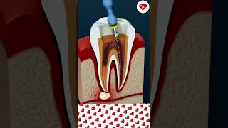 What are DENTISTS doing to your teeth shortsfeed shorts dentist animation [upl. by Ellerrehc]