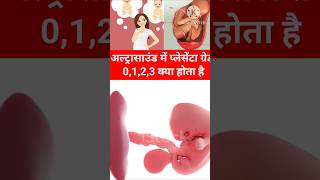 Pregnancy Ultrasound me Placenta Grade 0123 kya hota hai shorts pregnancy placenta pregnant [upl. by Jabin]