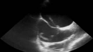 Thrombus in a Patent Foramen Ovale [upl. by Anuahsat394]