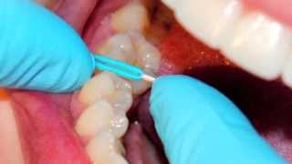 PHM Orthodontists Separator Video [upl. by Odelle374]