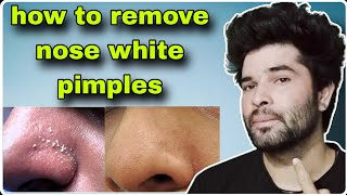 how to remove nose white pimples  nak ke pimples ko kaise hataye [upl. by Marrin]