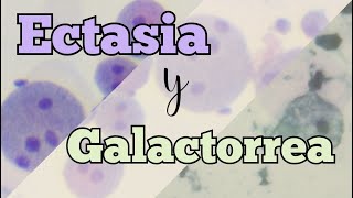 Ectasia y Galactorrea ¿Por qué se producen y cómo se diagnostican en citología [upl. by Elletsirk]