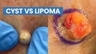 Cyst vs Lipoma Short Pops Compilation  CONTOUR DERMATOLOGY [upl. by Baram]